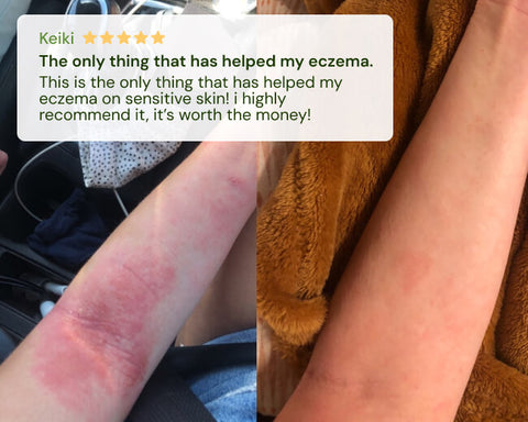 Close-up of skin with eczema symptoms and a five-star rating text overlay.
