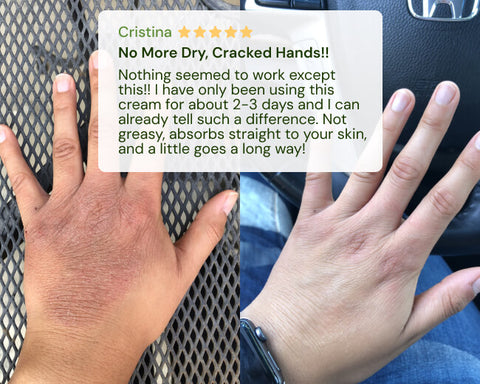 Hand with cracked skin holding a five-star review card for a hand cream.
