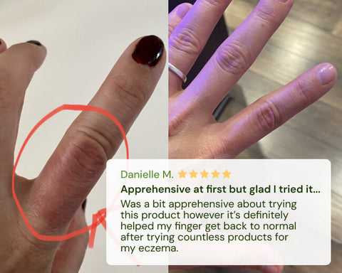 Finger eczema, before and after.